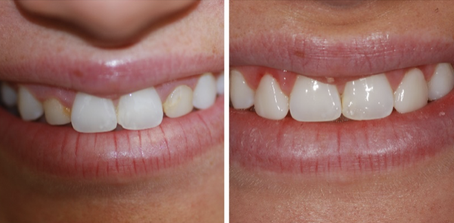 Cosmetic Tooth Bonding Indianapolis IN